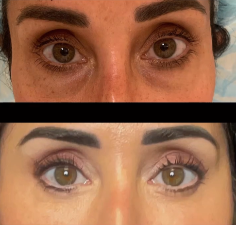 Lower Eyelid Blepharoplasty