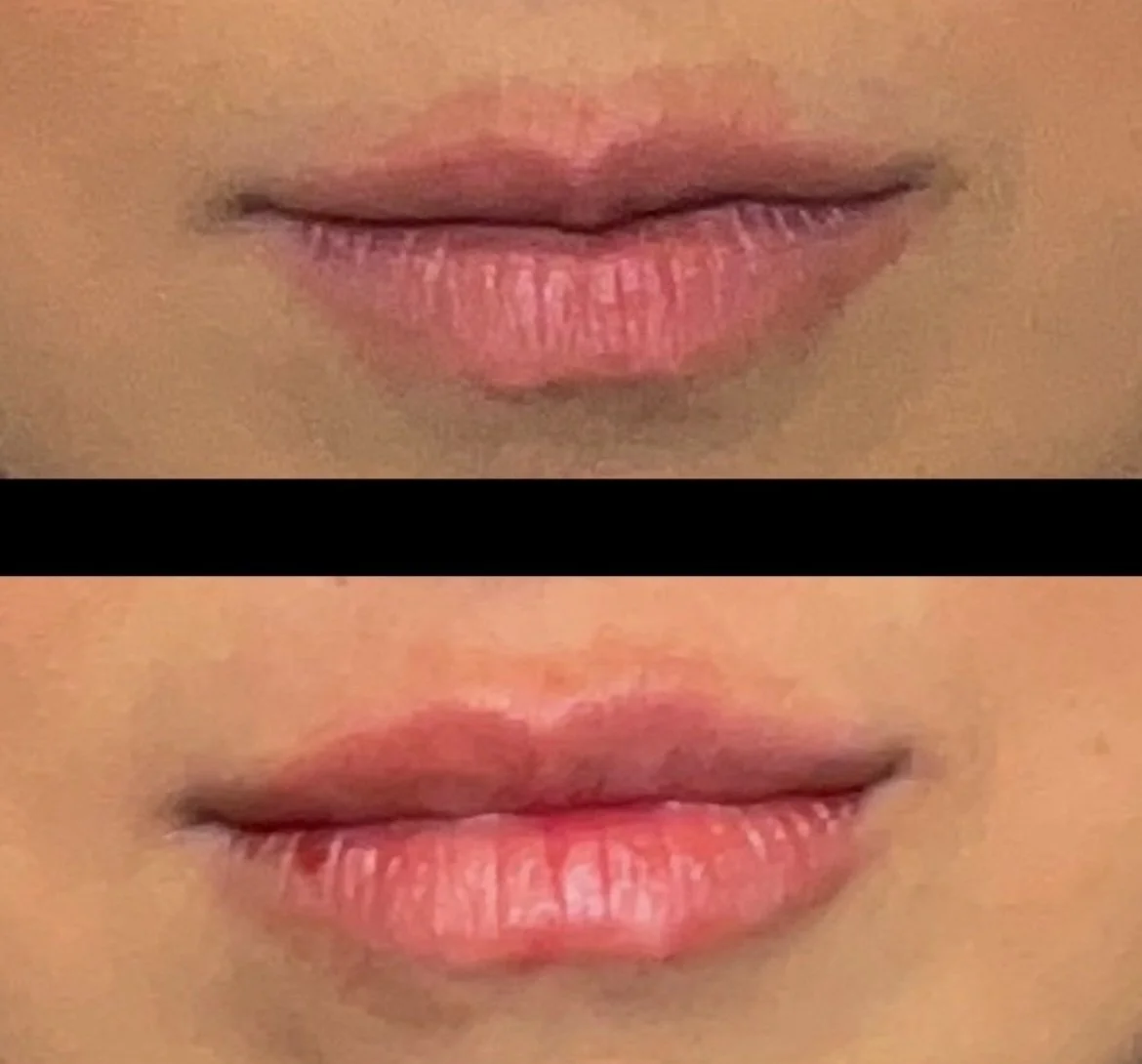 Lip Filler
