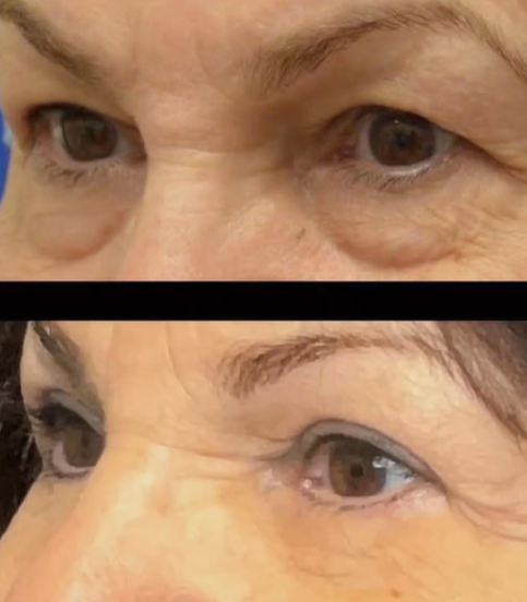 Lower Eyelid Blepharoplasty