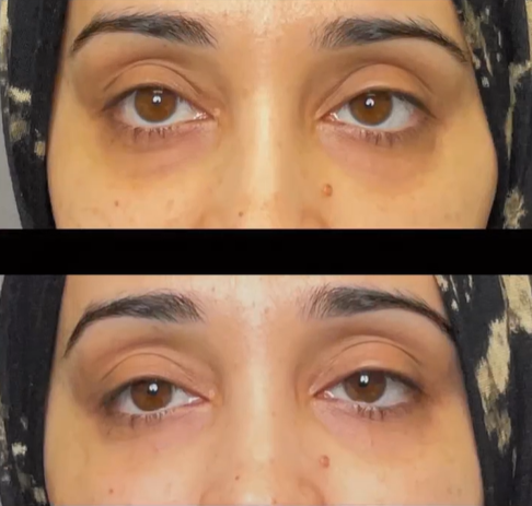 Non-invasive Under Eye Lift