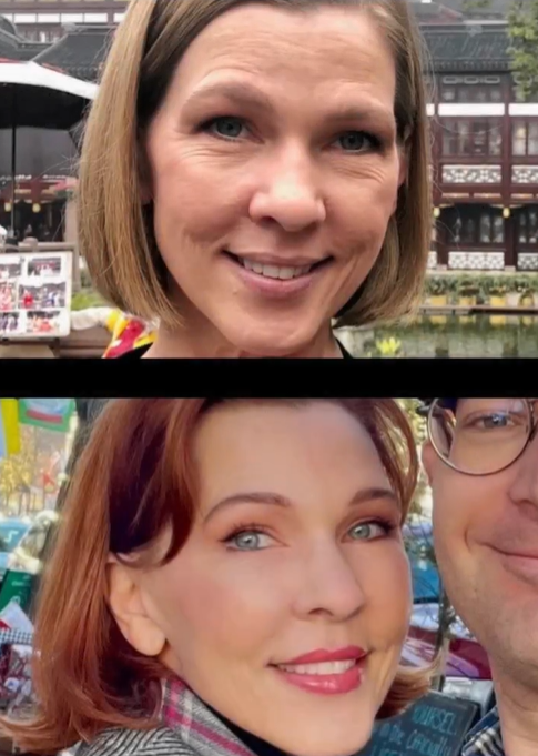 Upper Eyelid Blepharoplasty + Lower Eyelid Blepharoplasty + Brow Lift + Facelift