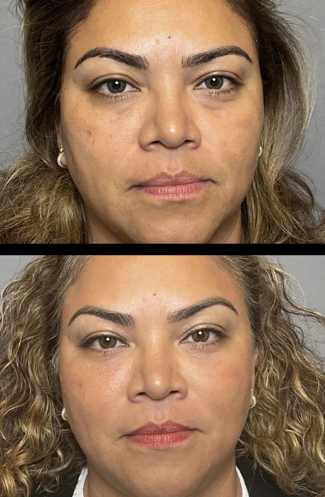 Non-Surgical Face Lift