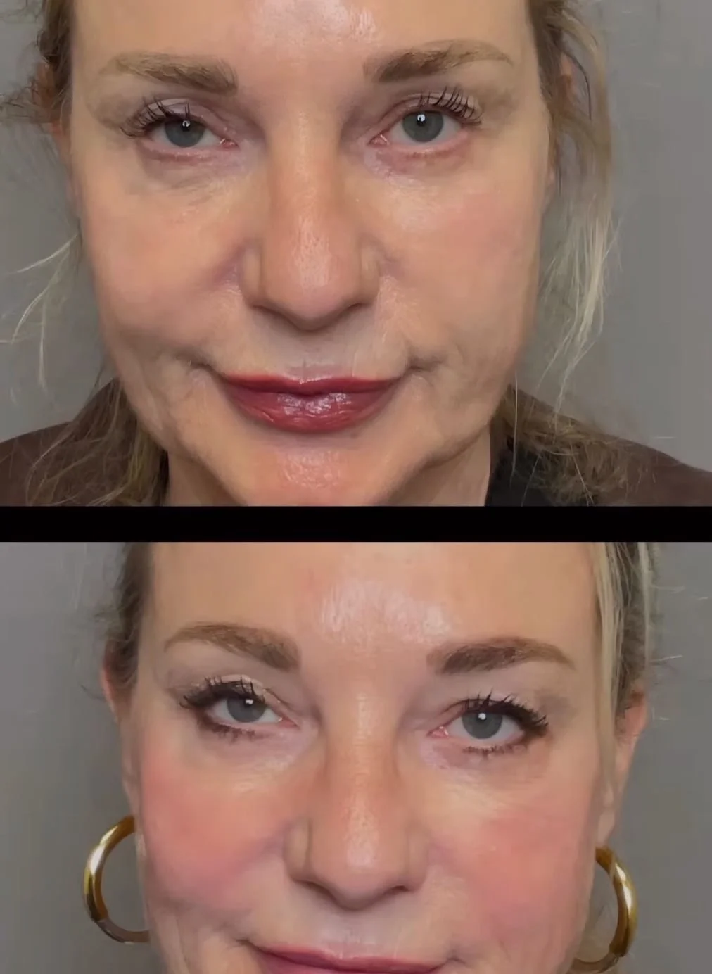 Anti-Aging Filler