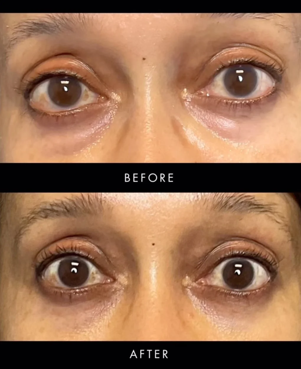 Bilateral Lower Blepharoplasty