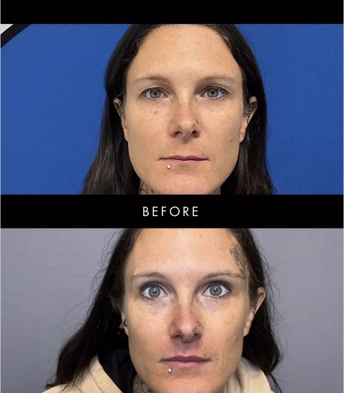 Upper Eyelid Blepharoplasty