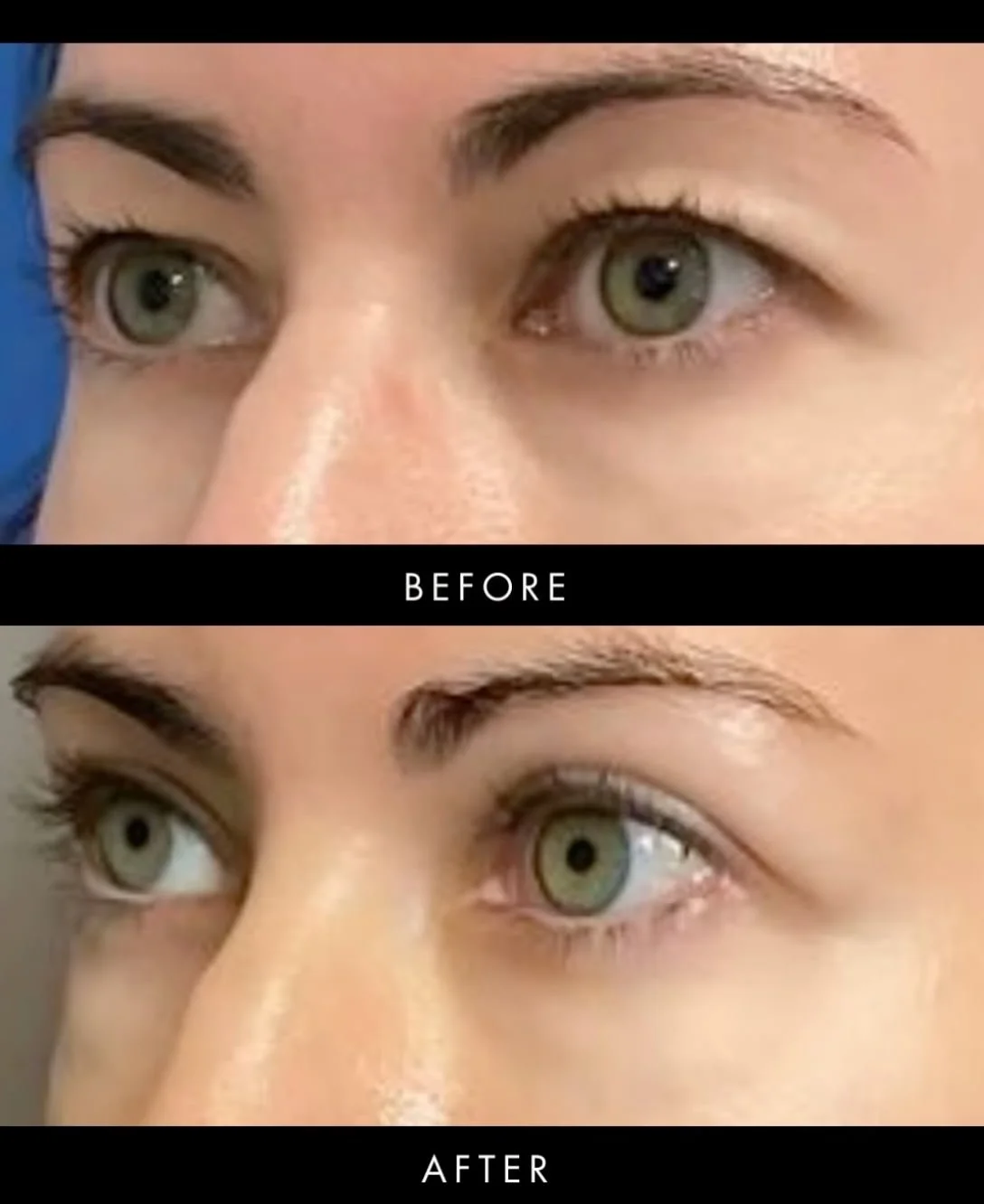 Bilateral Upper Blepharoplasty