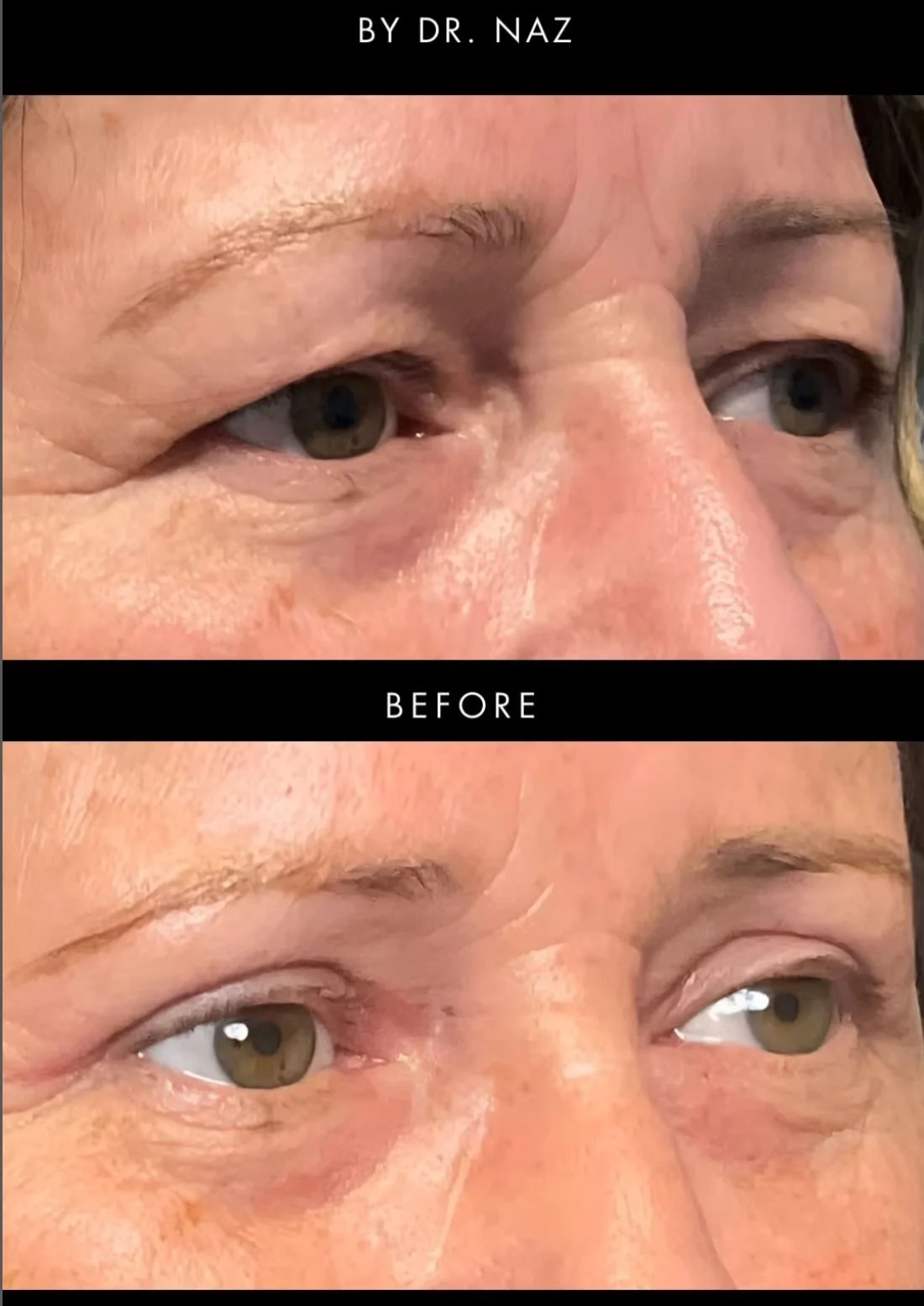 Upper Blepharoplasty