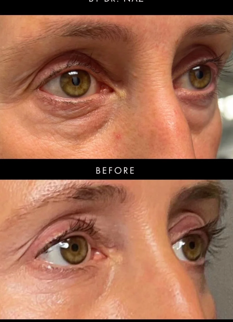 Lower Eyelid Blepharoplasty