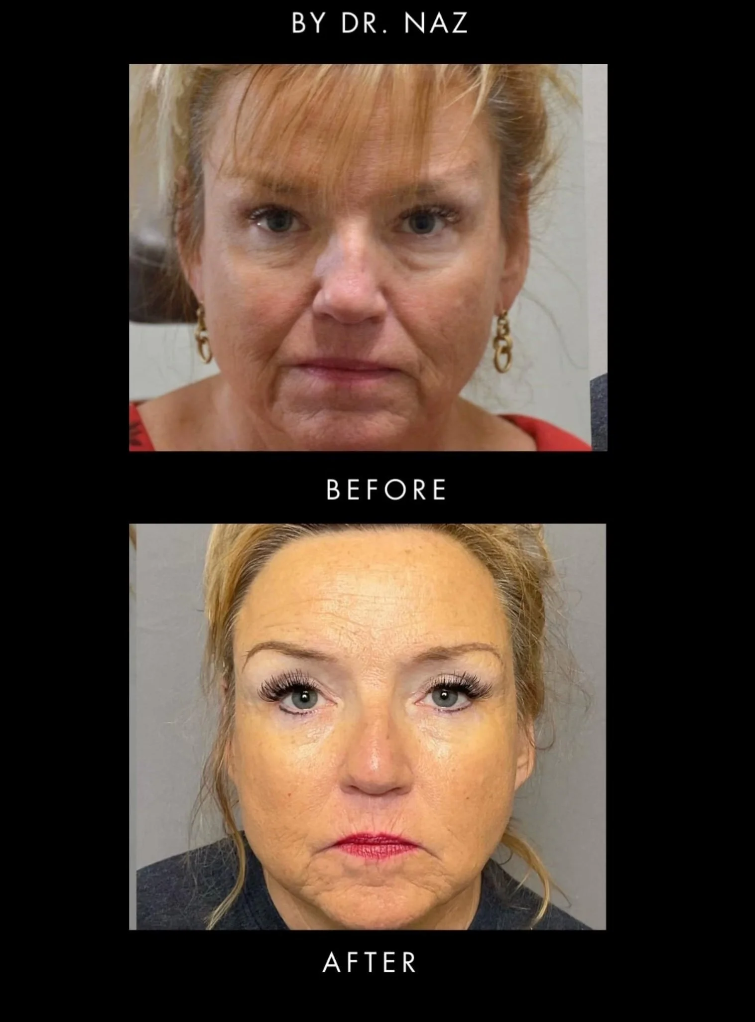 Upper Eyelid Belpharoplasty