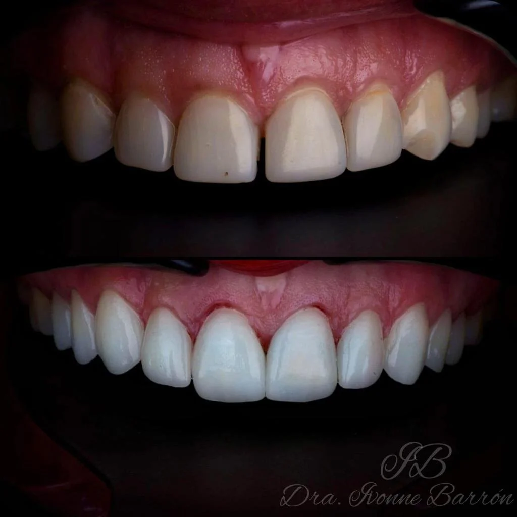 Veeners on a smile makeover