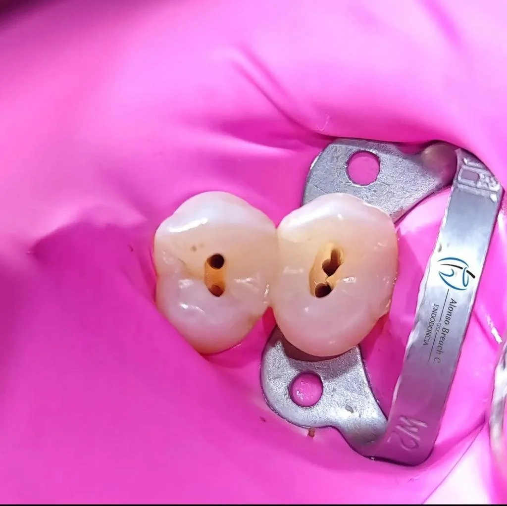 Root canal