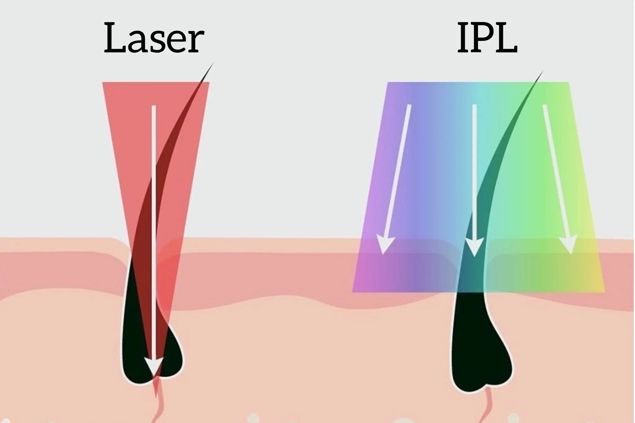 Laser vs IPL: What’s the Difference (and Which One is Better?) 
