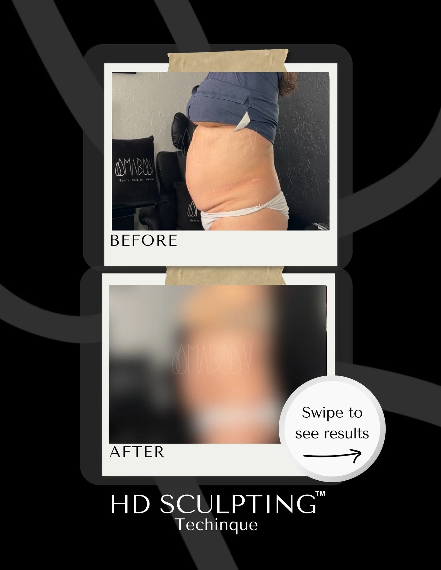 ✨After only 1 hour of our (non-invasive) HD Sculpting Technique&trade;️ on the stomach + sides 🙌

🌊This treatment pokes holes in the fat cell that leads into a big fat flush for 7 days! 

💉 A needle-free and surgery-free way to treat stubborn fat,