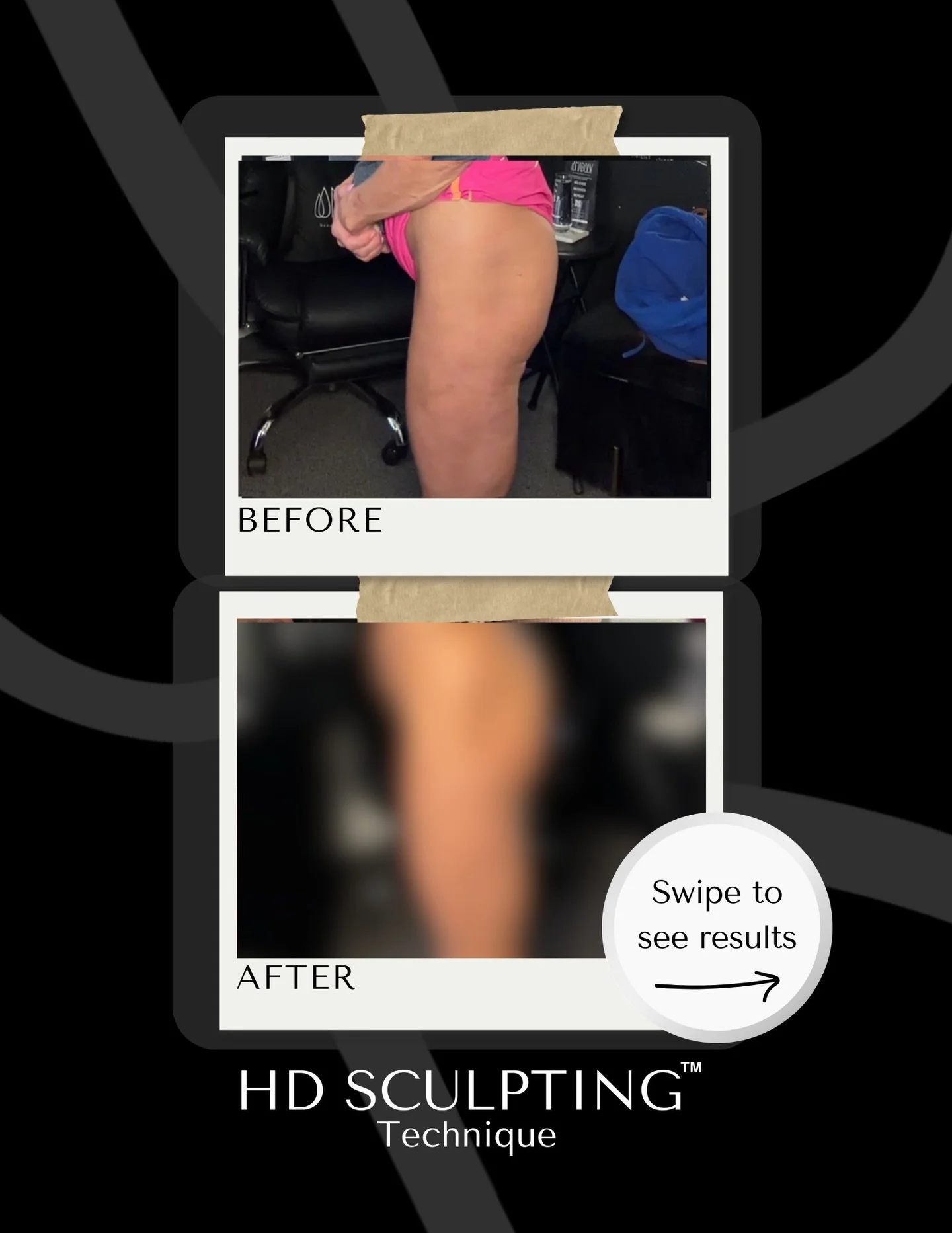 Sculpting confidence. One body at a time ✨

💚Our (non-invasive) HD Sculpting Technique&trade;️ 

🌊This treatment pokes holes in the fat cell that leads into a big fat flush for 7 days! 

💉 A needle-free and surgery-free way to treat stubborn fat, 