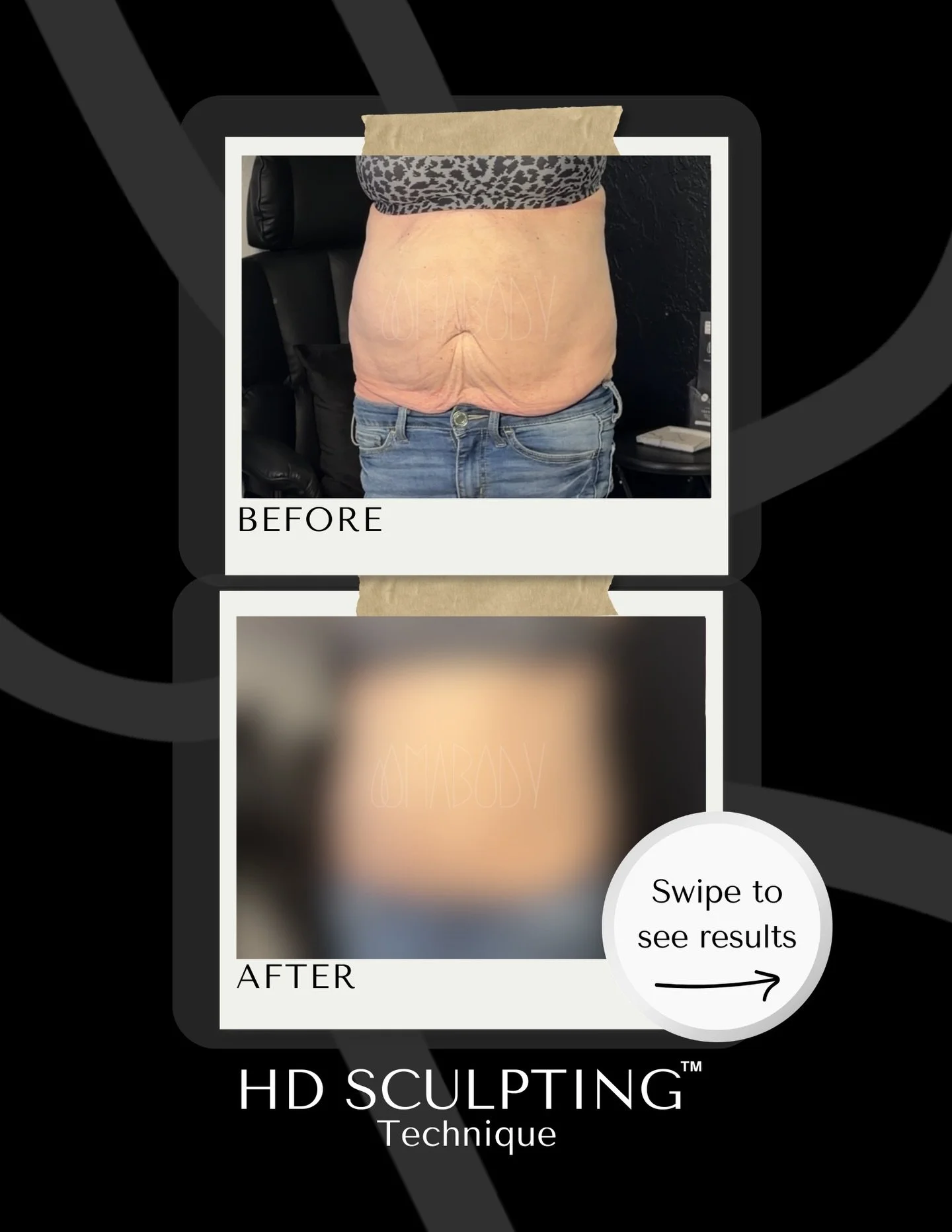 Consistency is the best luck charm 🍀 

✨After only 1 hour of our (non-invasive) HD Sculpting Technique&trade;️ 🙌

🌊This treatment pokes holes in the fat cell that leads into a big fat flush for 7 days! 

💉 A needle-free and surgery-free way to tr