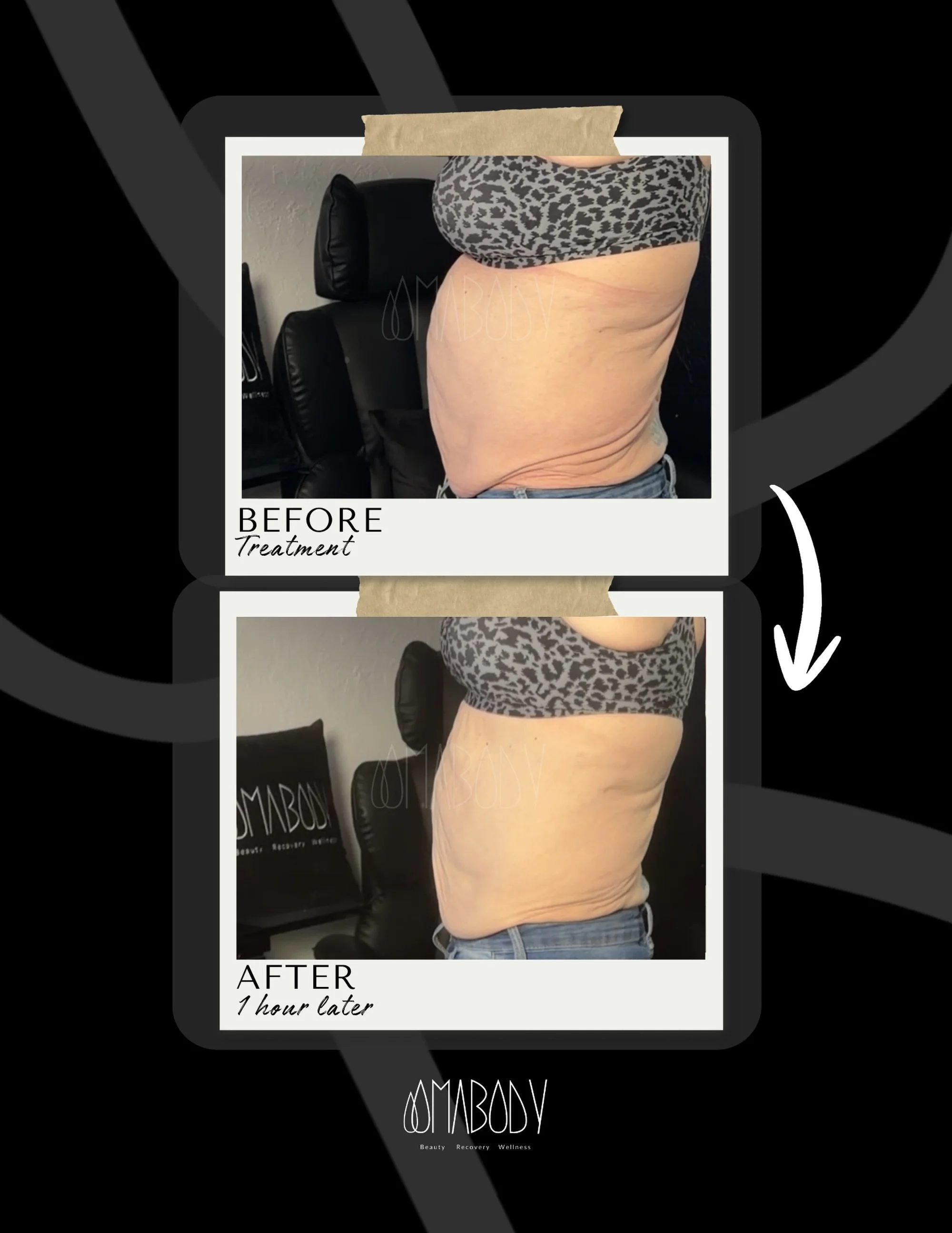 ✨After only 1 hour of our (non-invasive) HD Sculpting Technique&trade;️ 🙌

🌊This treatment pokes holes in the fat cell that leads into a big fat flush for 7 days! 

💉 A needle-free and surgery-free way to treat stubborn fat, naturally

🗓️ Same da