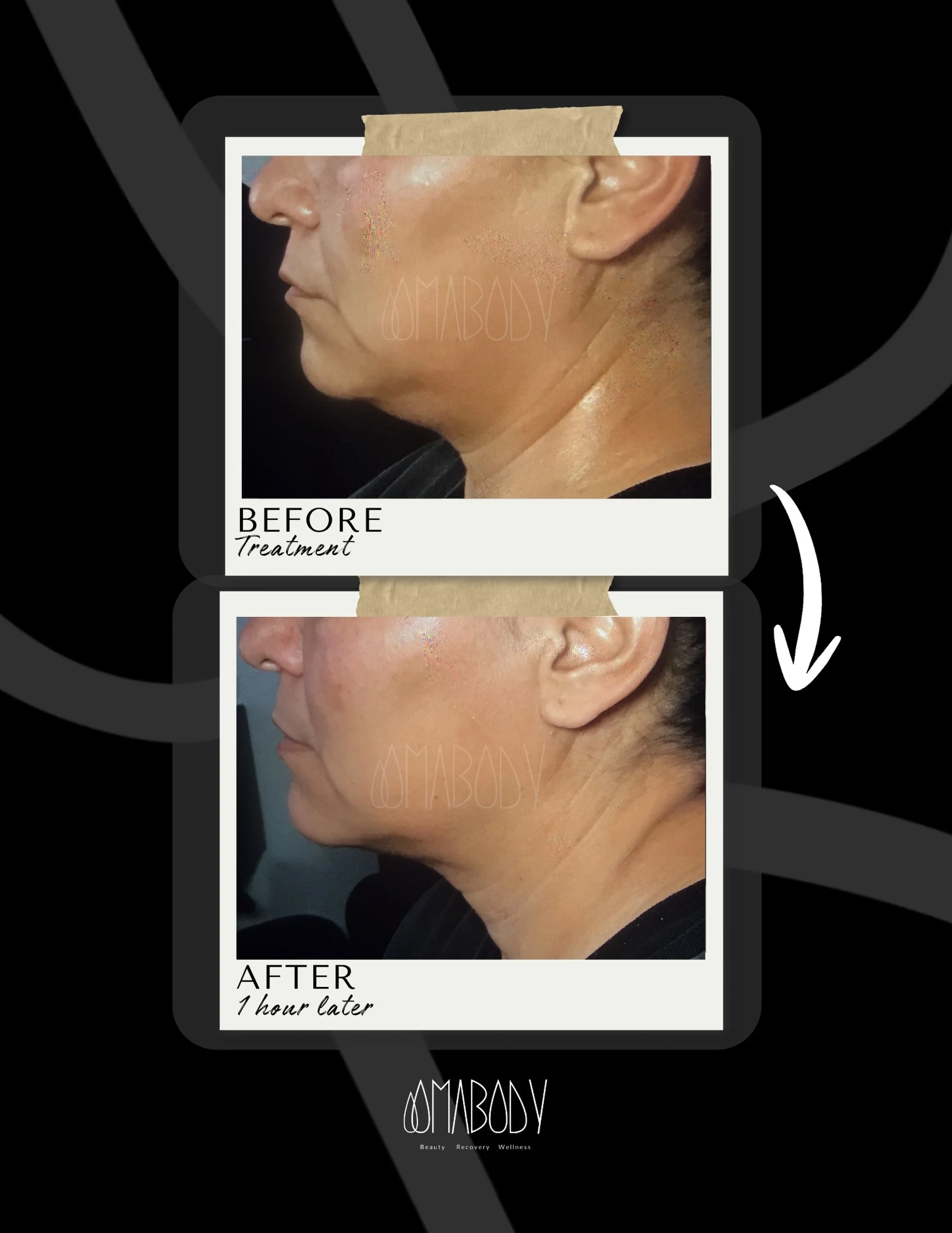 Mini-FaceLift 🥰💐 

Our face ages because we lose collage, structural support and adequate circulation. Our NoTox Technique remodels the face from the inside out. Stimulating collagen, supporting structural connective tissue and improving blood and 