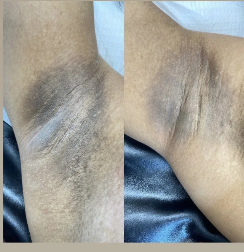 the-norie-method-underarm-hyperpigmentation.jpeg
