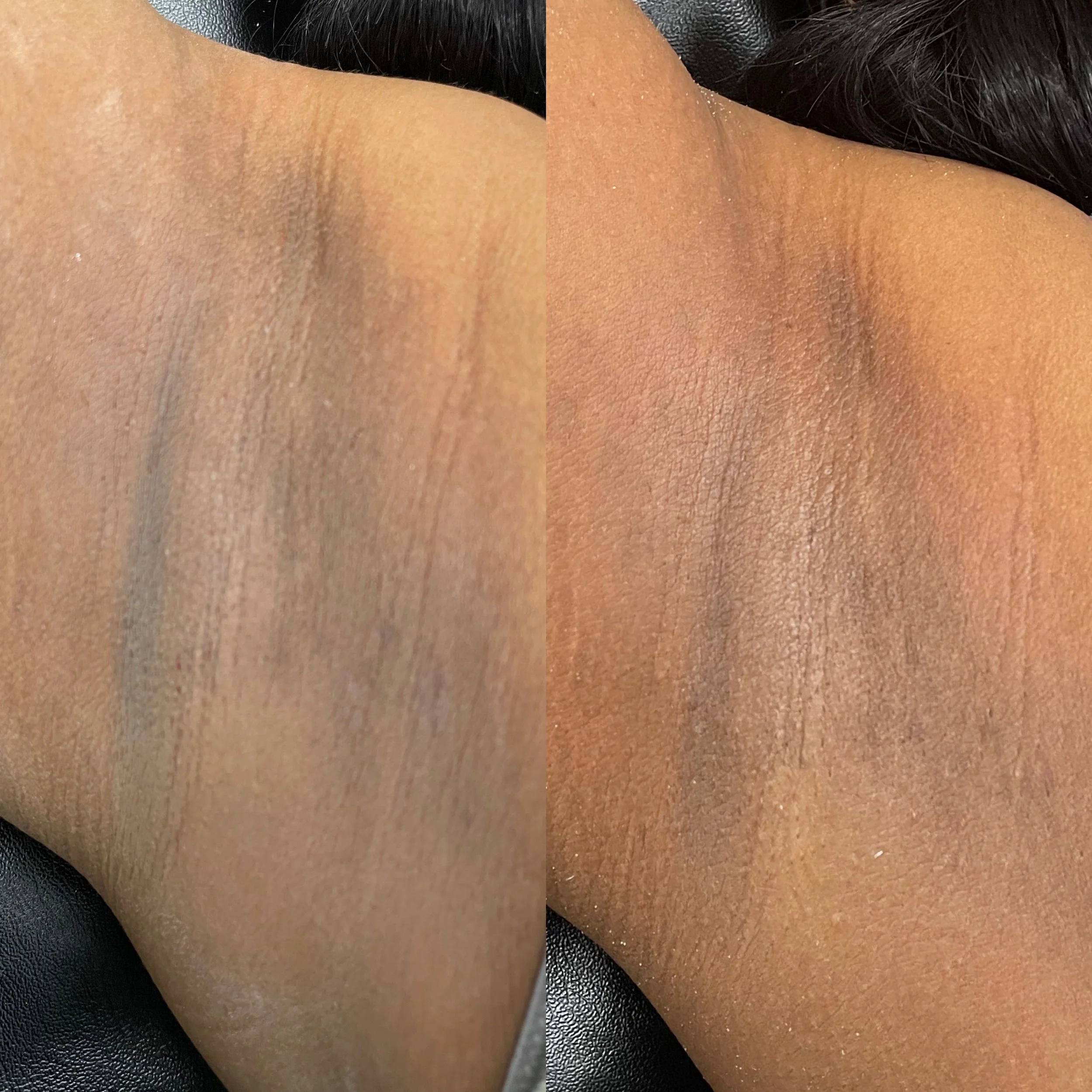 the-norie-method-lightend-underarms-hyperpigmentation-treatment.jpeg