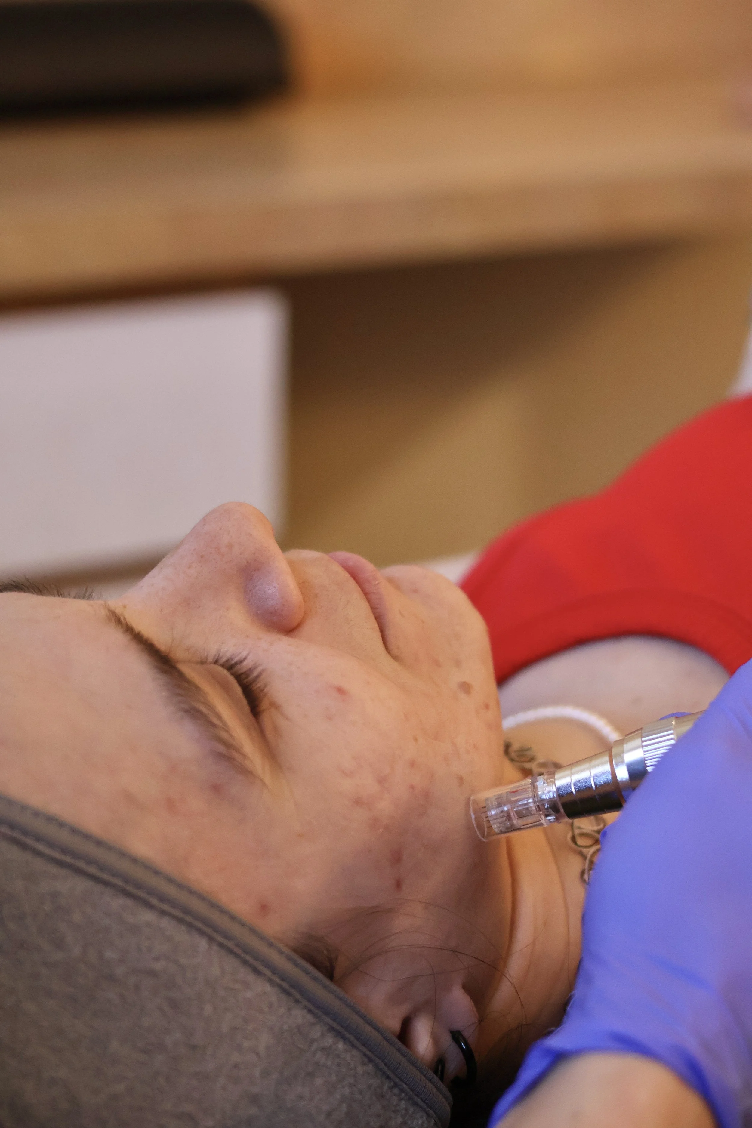 A person's face with a practitioner providing a Microneedling treatment