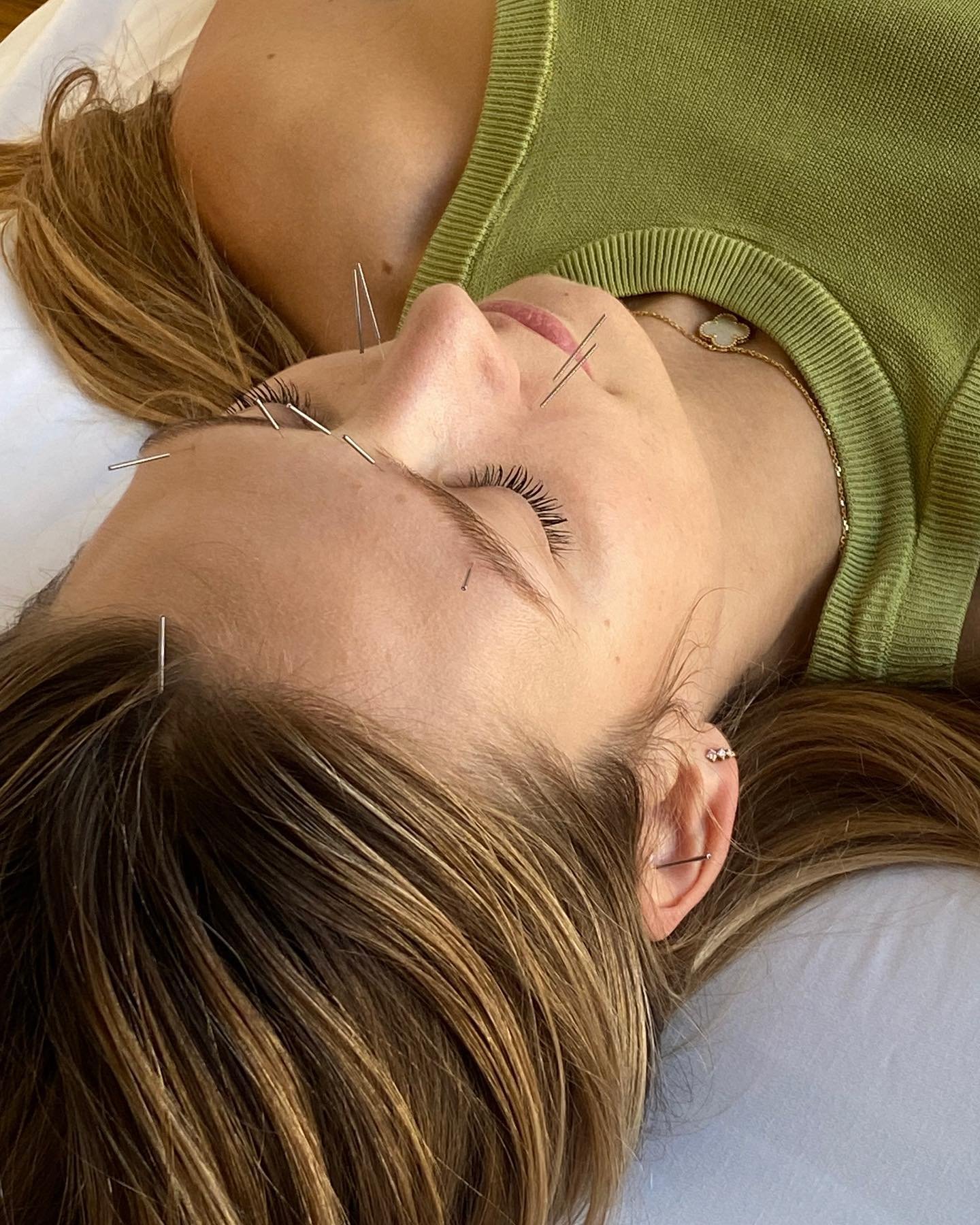 Is facial acupuncture nature&rsquo;s alternative to botox?

The benefits certainly speak for themselves! ✨

This treatment is specifically designed to improve facial appearance by reducing fine lines and wrinkles, improving facial muscle tone, and re