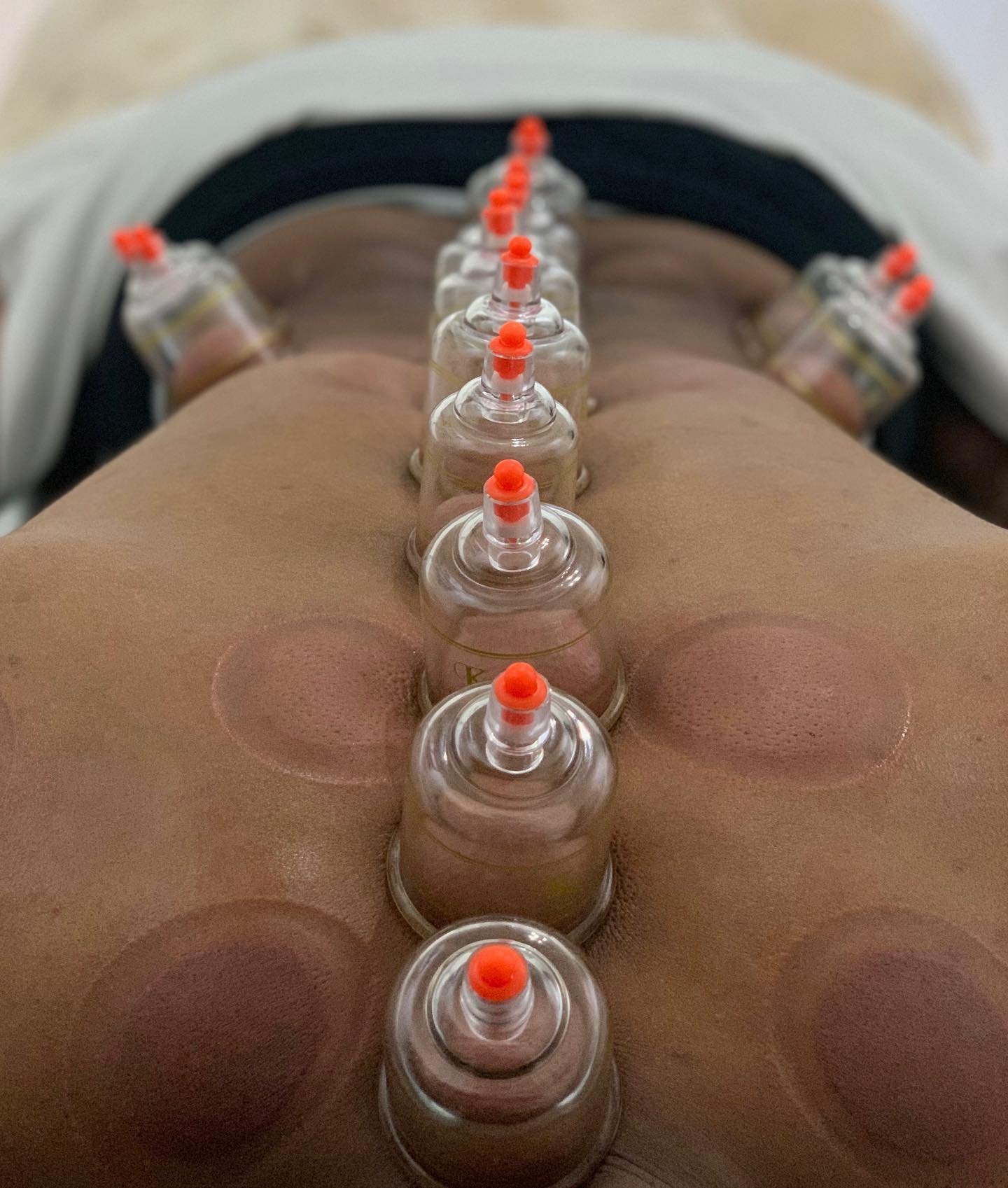 Looking for a natural way to promote healing and relaxation? 

Cupping therapy might just be the solution you&rsquo;ve been searching for! 

Cupping has many amazing benefits, including:
✓ eases muscle tension + reduce pain
✓ promotes relaxation + st
