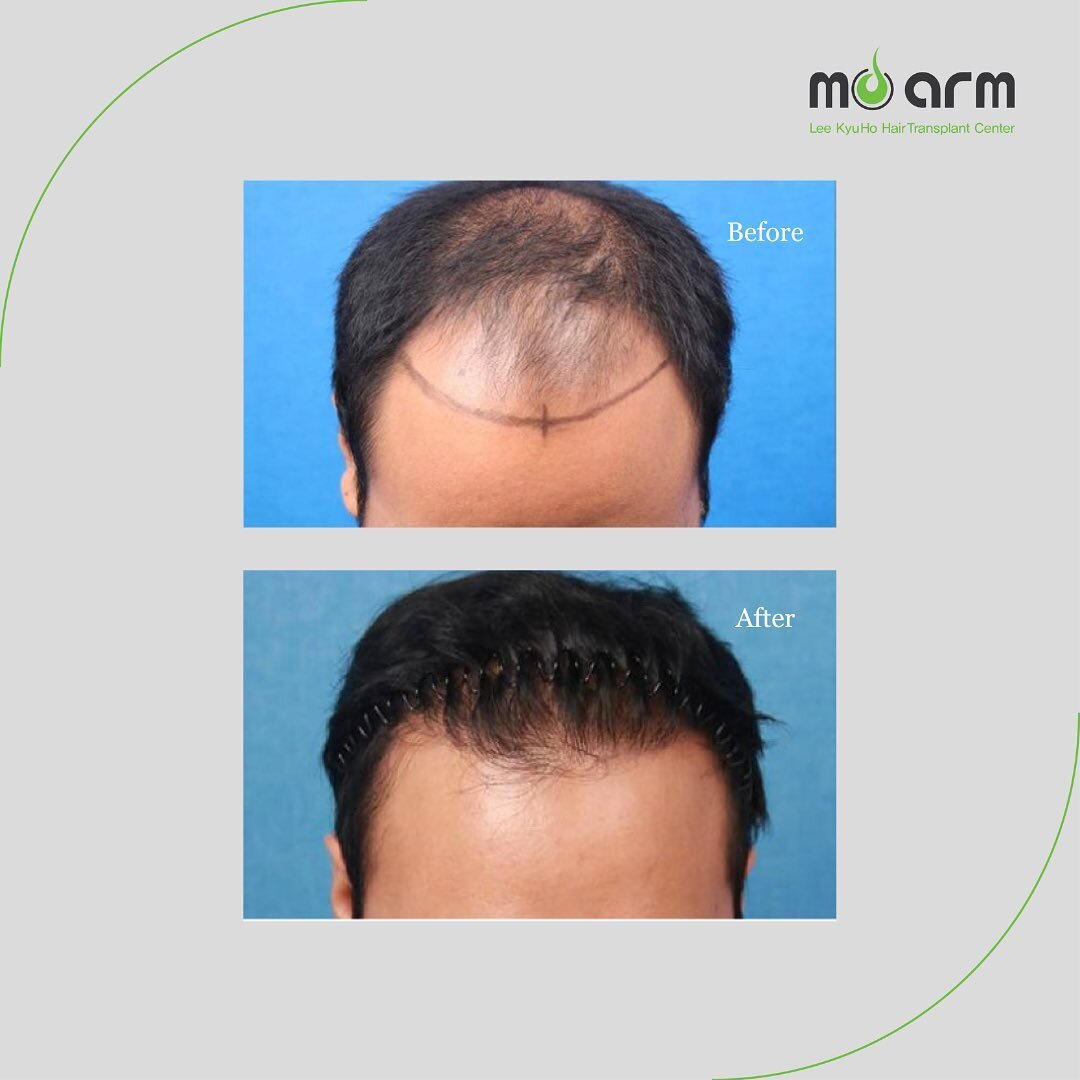 Moarm&rsquo;s Before &amp; After

✔️Male FUE Hair Transplant
✔️2,500 grafts
✔️One year post-op

Amazing natural result by Dr. Kyuho Lee 🌿

#hairtransplantkorea #koreahairtransplant