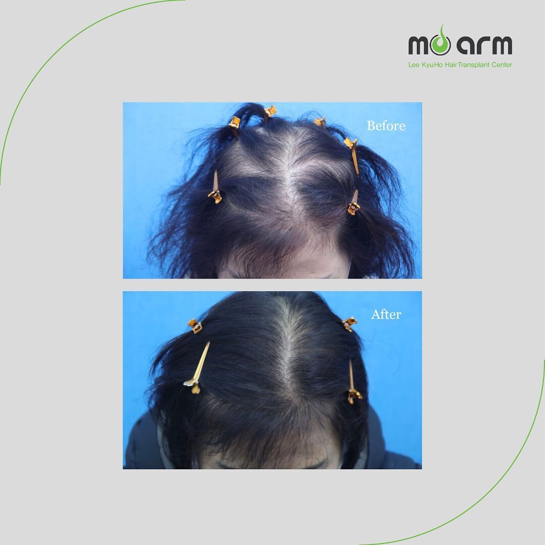 Moarm&rsquo;s Before and After

Check out Dr. Lee Kyuho&rsquo;s amazing result on female hair transplant. This patient had concern of low density, hair thinning, and overall hair loss.

Female FUE Hair Transplant
✔️Non-invasive
✔️2,000 grafts
✔️One y