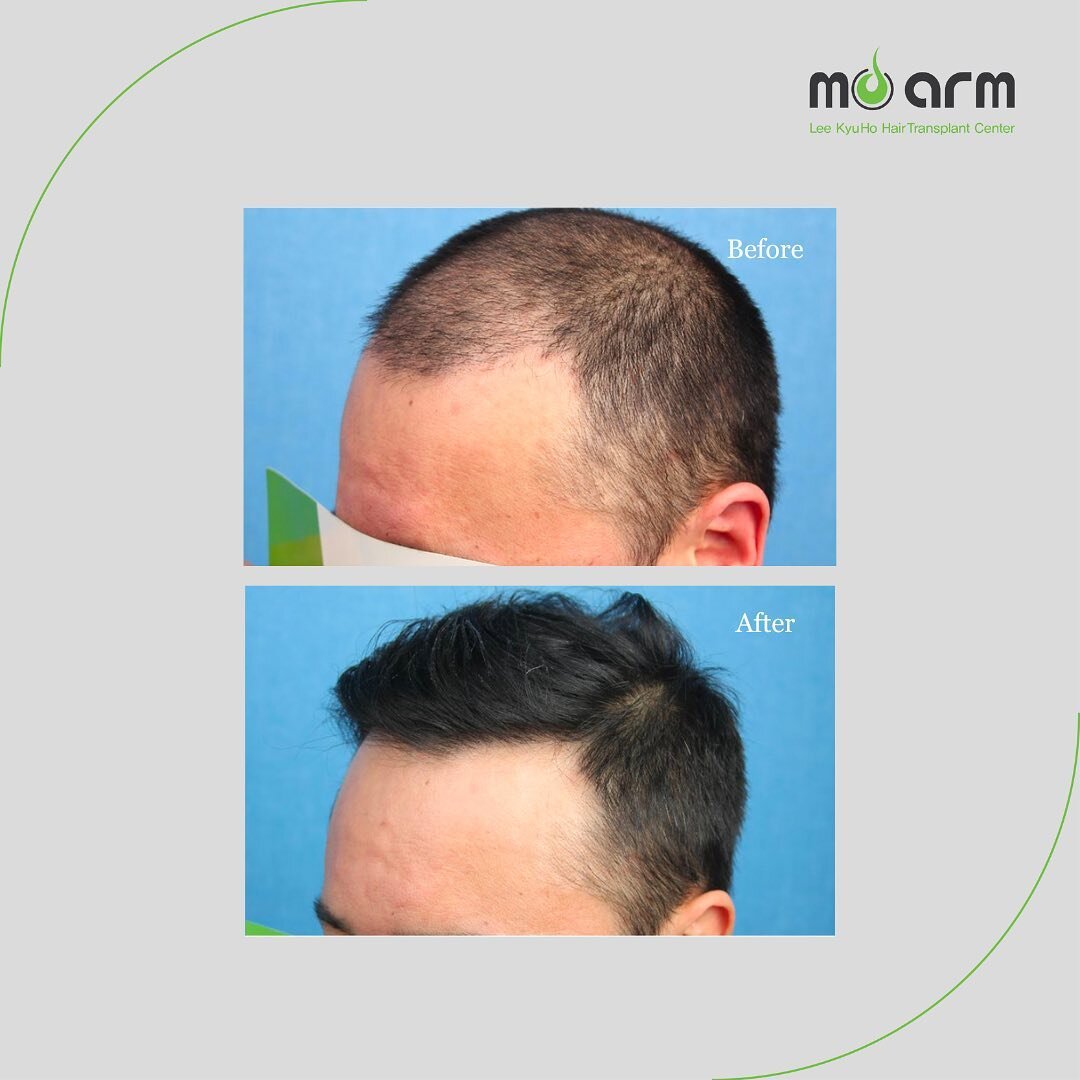 Moarm FUE Before &amp; After

See amazing result from Dr. Kyuho Lee, the best FUE hair transplant surgeon in Korea.

✔️Male FUE Hair Transplant
✔️1,800 Grafts
✔️One Year Post Op
✔️Non-invasive method

#moarmhairtransplant #moarmclinic #moarmkorea