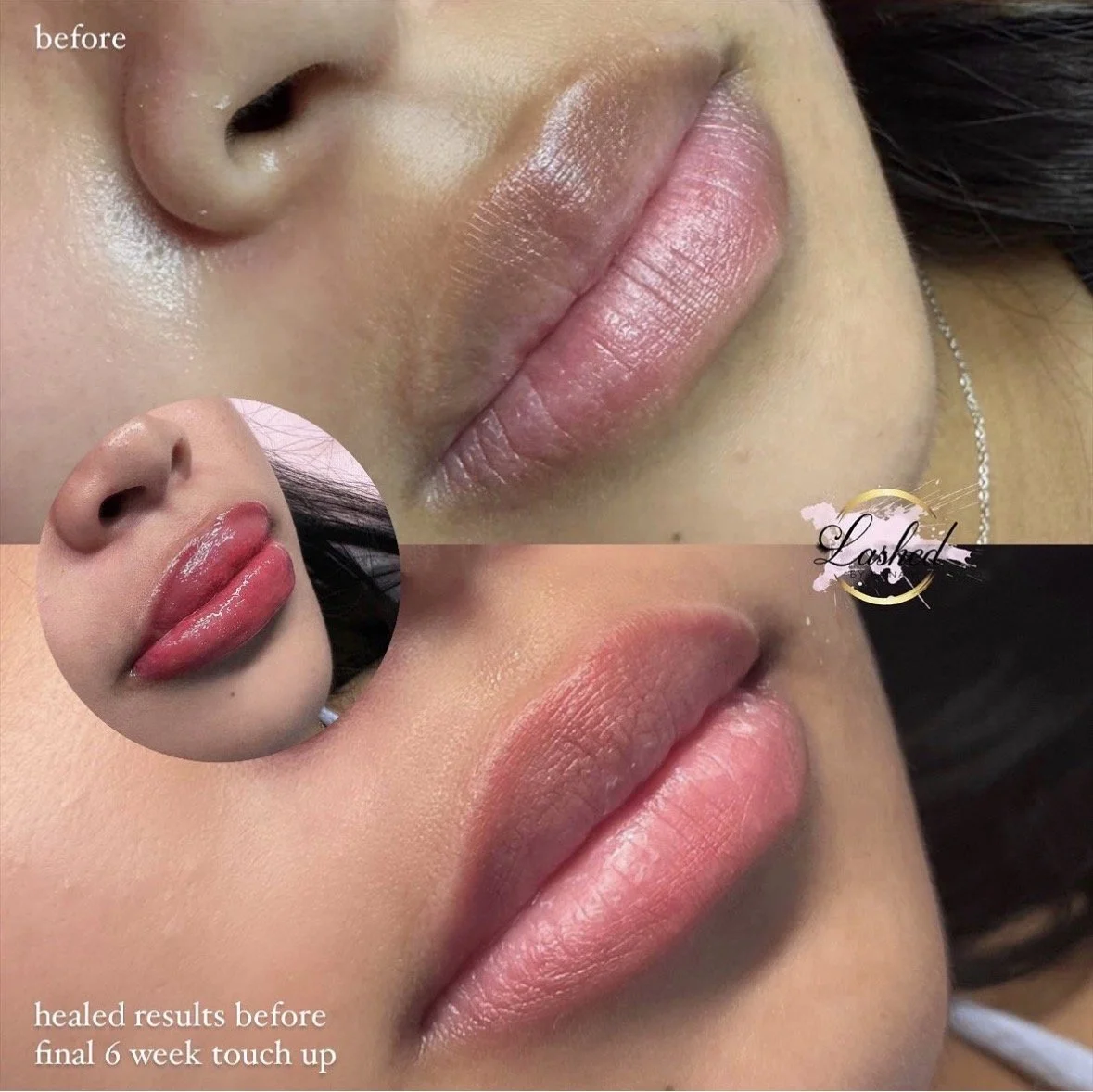 Close-up of lips before and after a 6-week lip enhancement treatment, showing smoother, fuller lips.