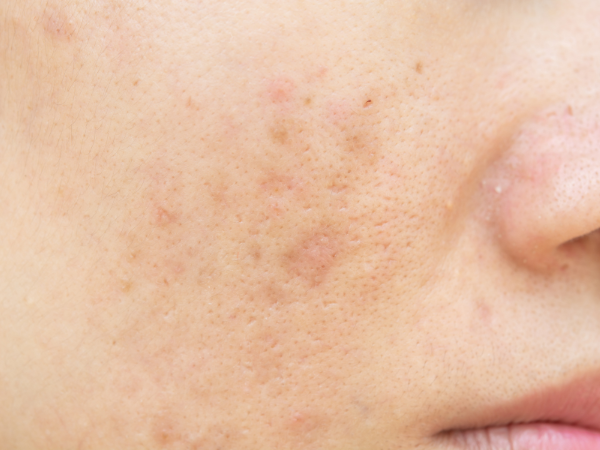 Age Spots