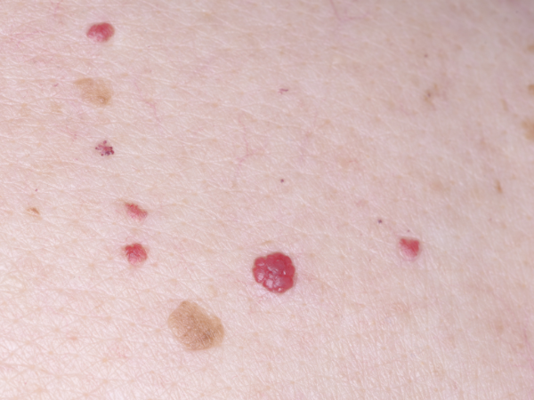 Cherry Angioma (aka Blood Spots)