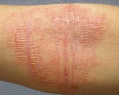 Dermatoses Lichenification