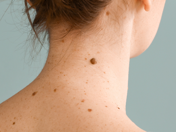Mole Reduction