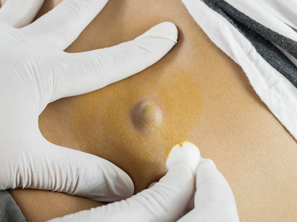Sebaceous Cysts
