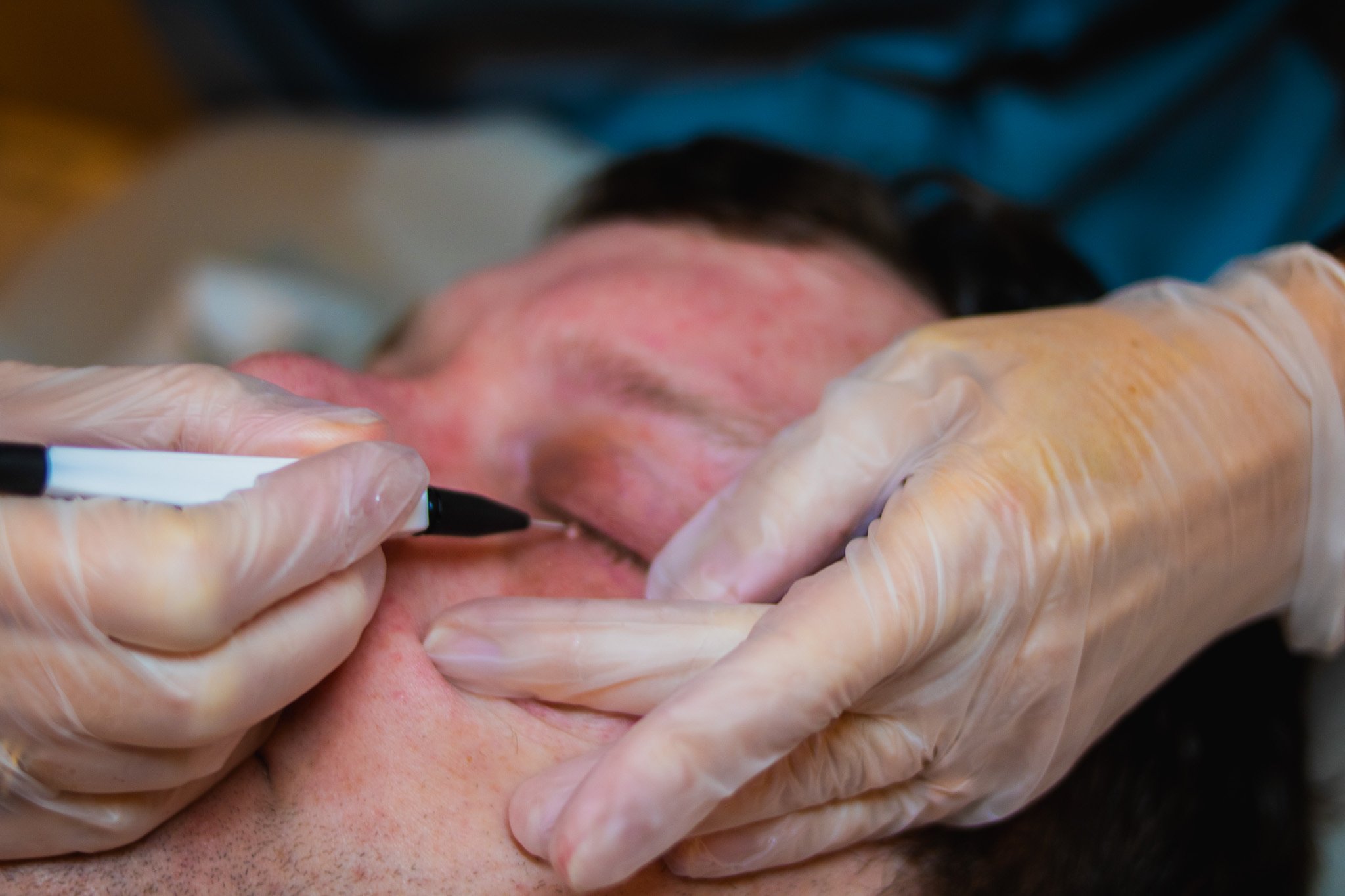 essential_maintenance-blemish_removal-skin_tag.jpg