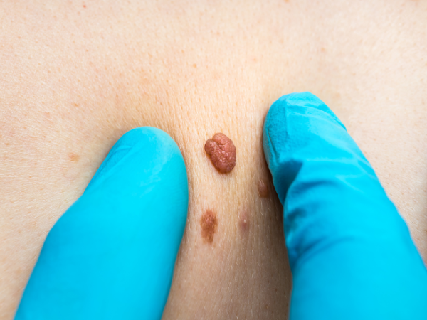 Skin Tags