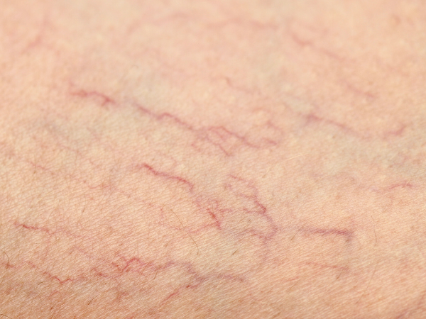 Spider Veins (aka Thread Veins)