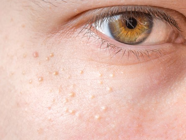 Syringomas