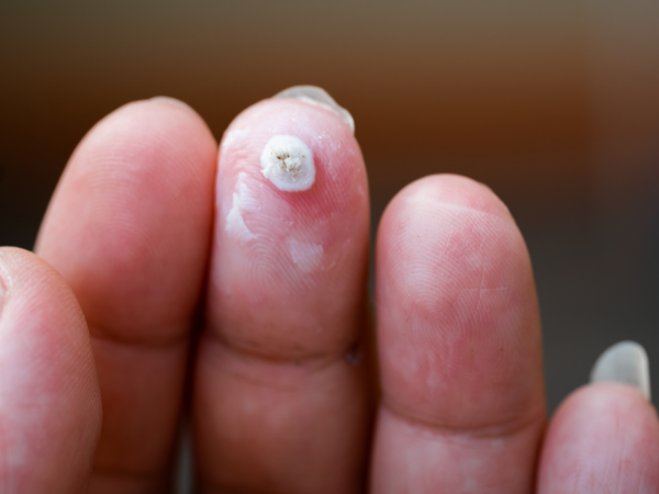 Warts