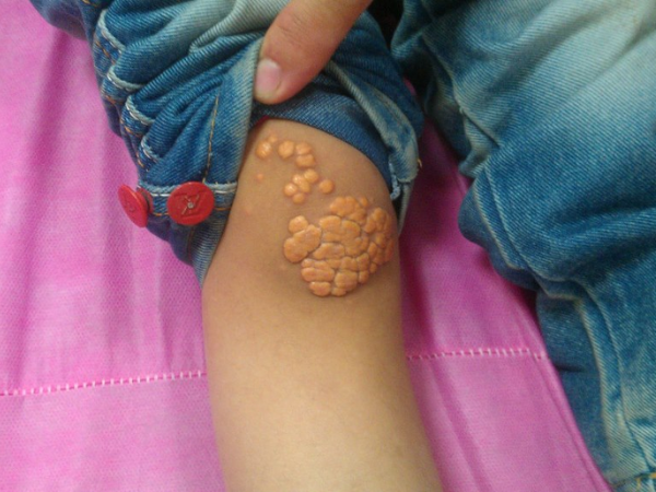 Xanthoma