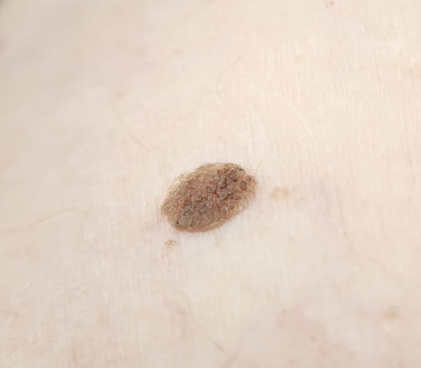 Seborrheic Keratosis
