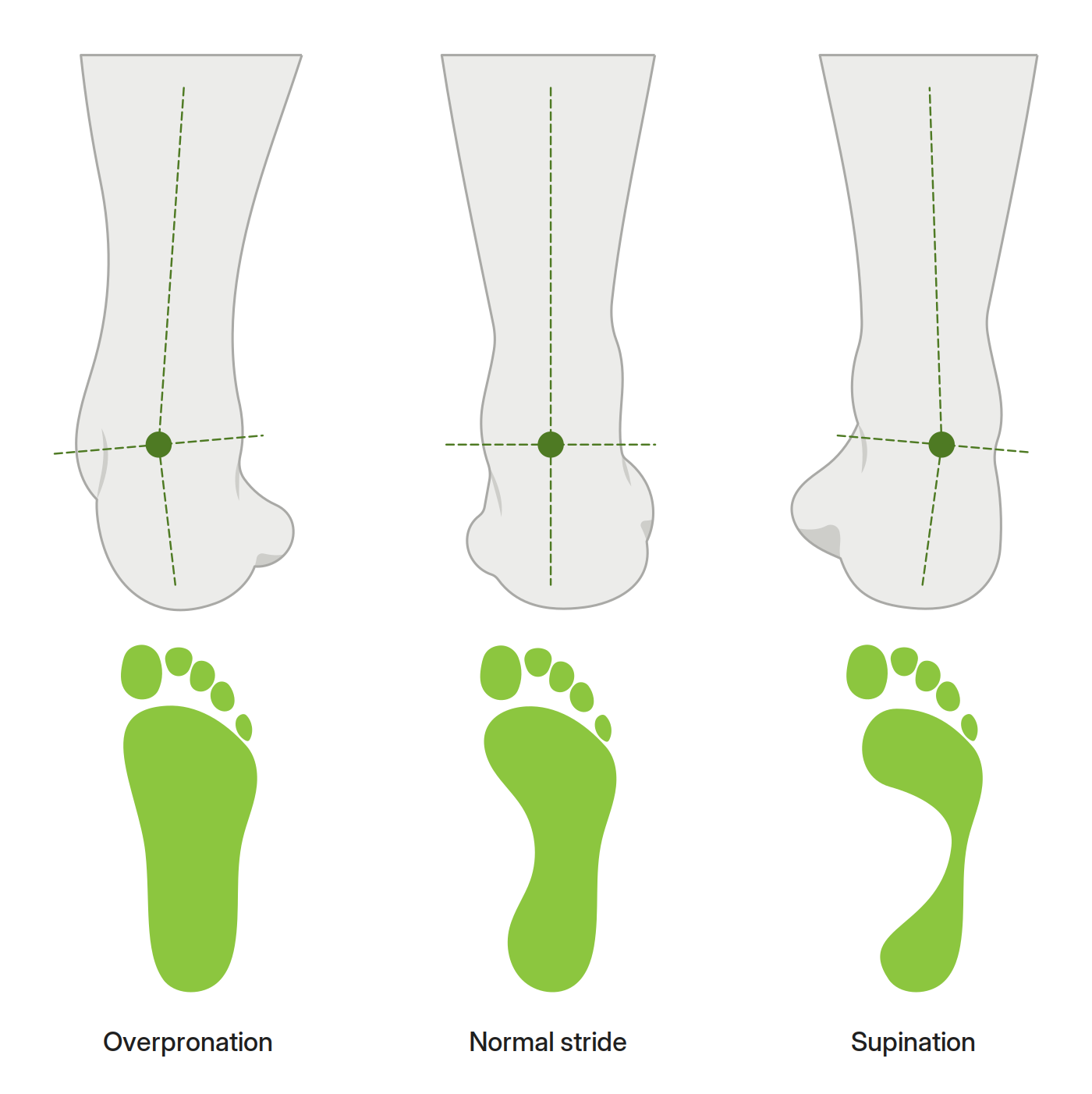 Rear-view diagram comparing overpronation, normal stride, and supination with footprint pressure patterns
