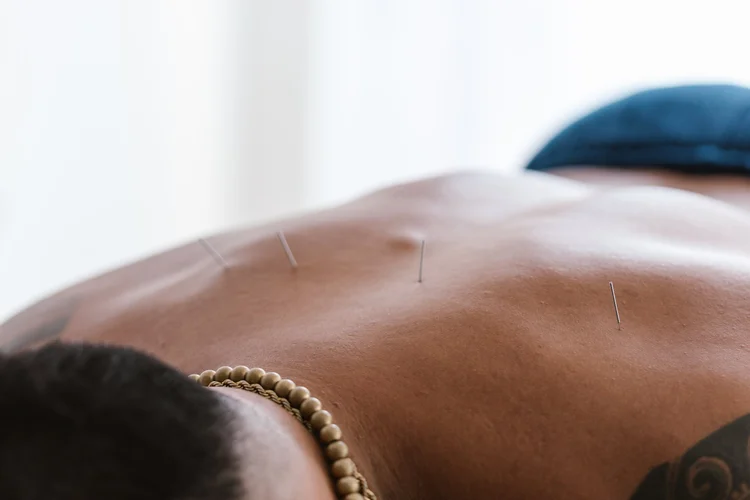 Dry needling service