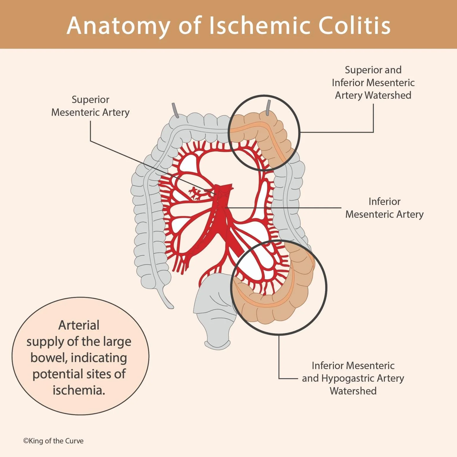 🚨 Ischemic Colitis: The Watershed Zones You Can’t Forget for the MCAT