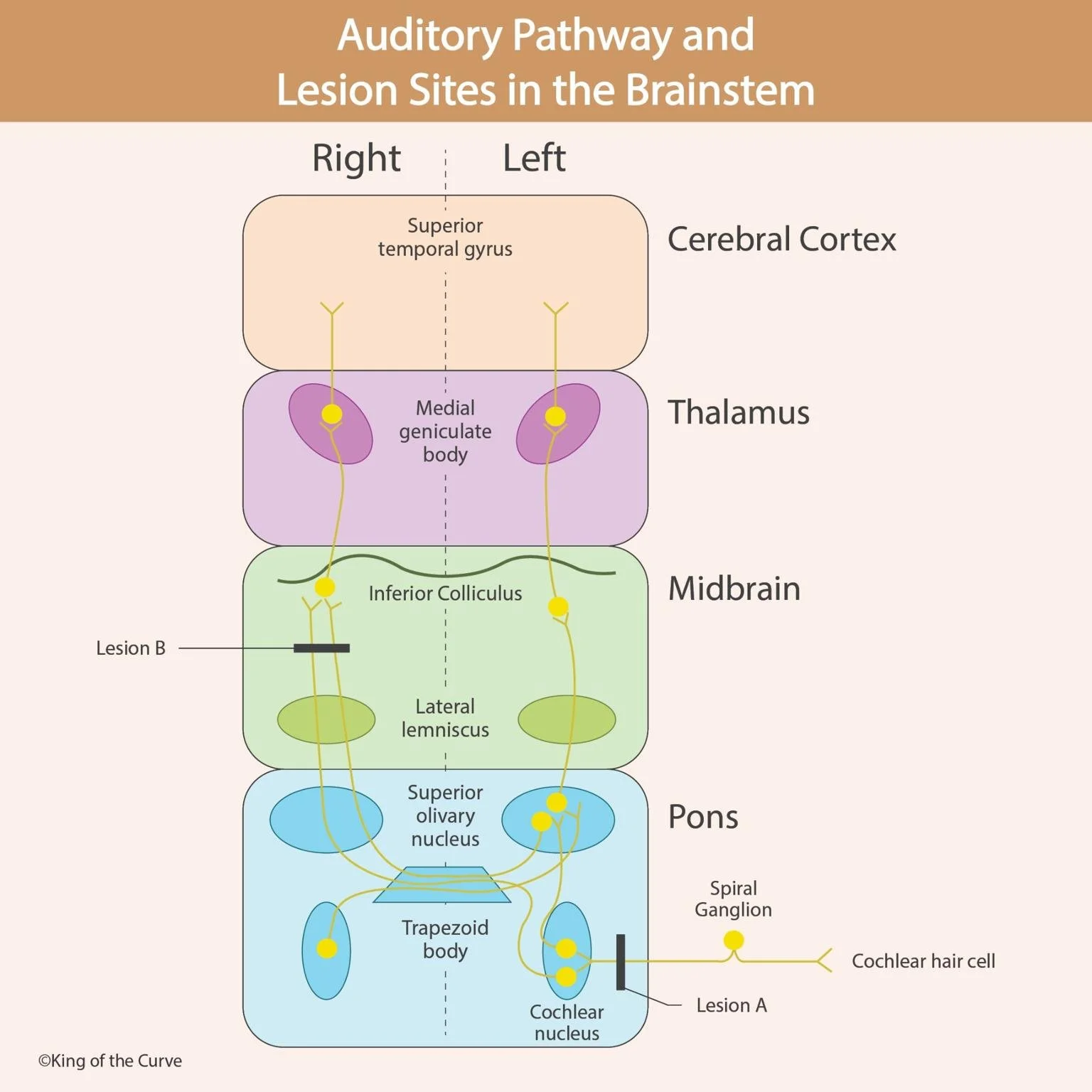 🧠 Auditory Pathway and Lesion Sites in the Brainstem