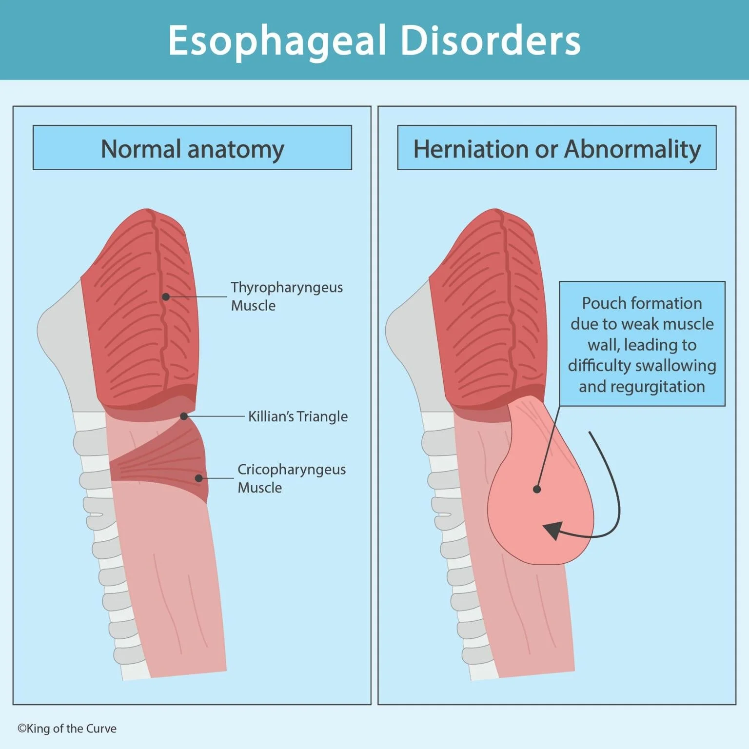 🔹 Esophageal Disorders: Anatomy and Abnormalities