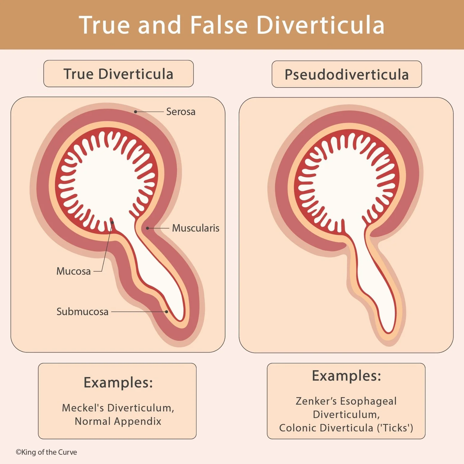 🧠 True vs False Diverticula Explained (High-Yield GI Anatomy for MCAT, NCLEX, and USMLE)