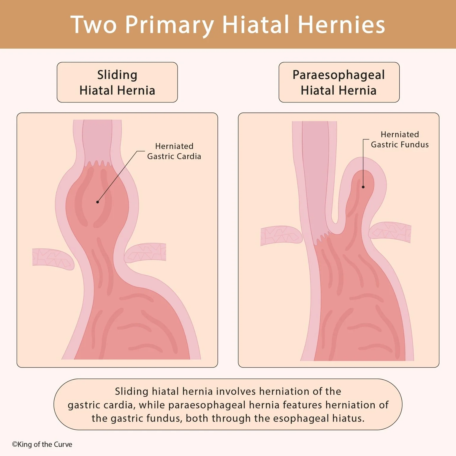🩺 Sliding vs Paraesophageal Hiatal Hernias Explained (High-Yield GI Anatomy for MCAT, NCLEX &amp; USMLE)