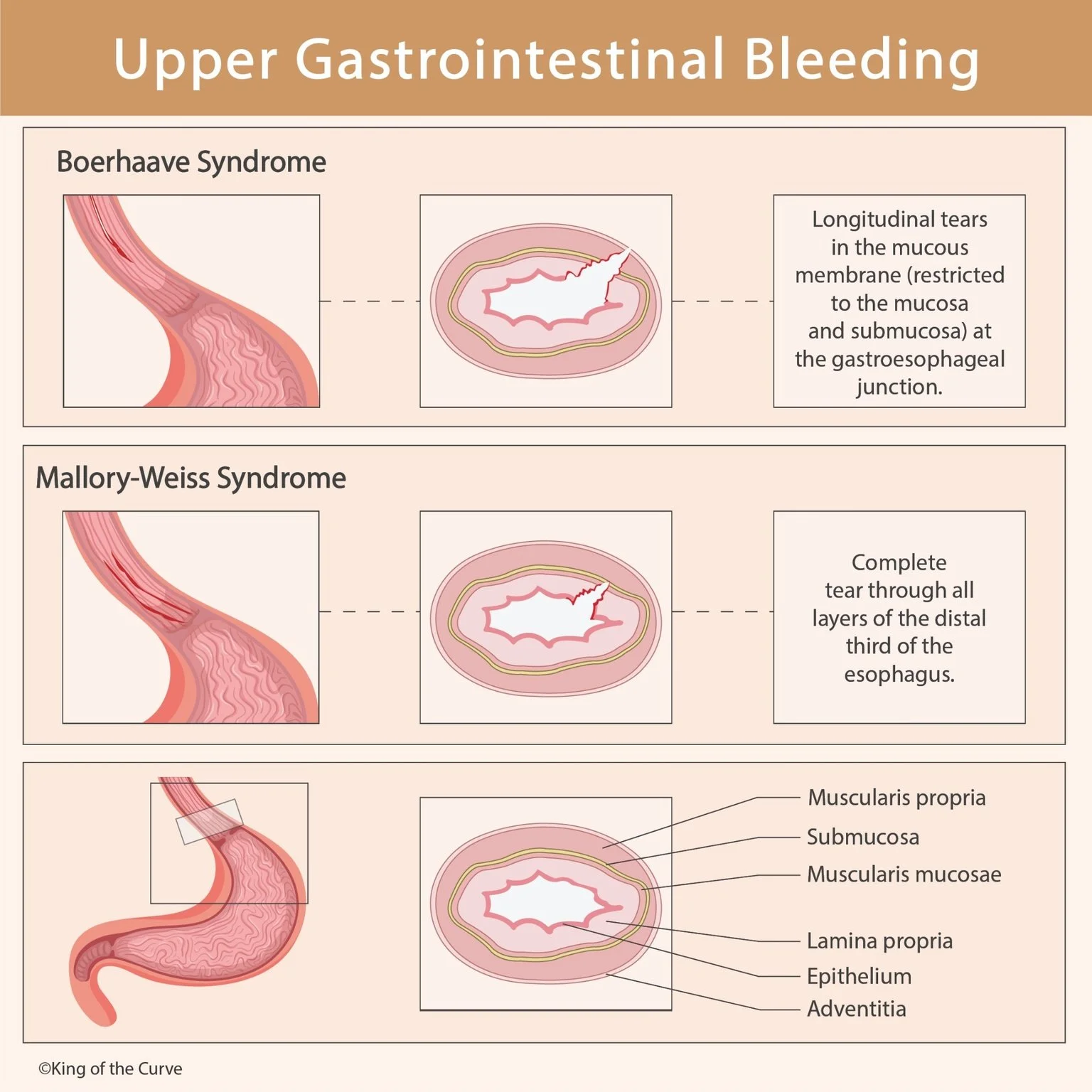 Upper Gastrointestinal Bleeding: Boerhaave vs Mallory-Weiss Syndrome